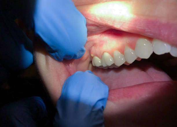 Best Emergency Wisdom Tooth Extraction in Loudonville, OH